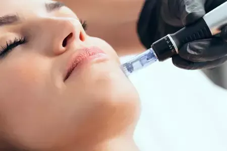Microneedling